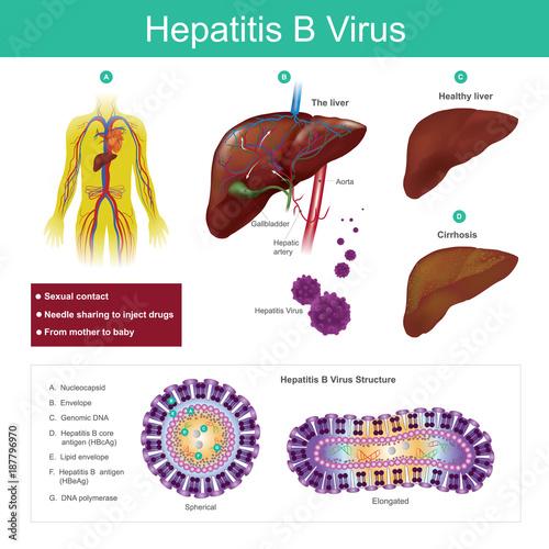 Hepatitis B virus. The virus is mainly transmitted by sexual contact, needle sharing to inject drugs and from mother to baby. Illustration. photo
