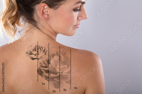 Laser Tattoo Removal On Woman's Shoulder