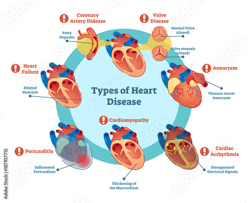 Types of heart disease collection, vector illustration diagram. Educational medical information. 
