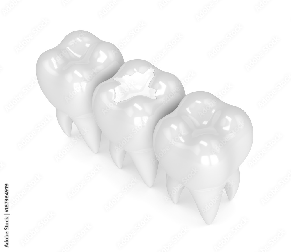 3d render of teeth with dental composite filling 3d render of teeth with dental composite filling