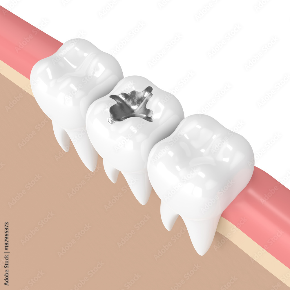 3d render of teeth with dental amalgam filling