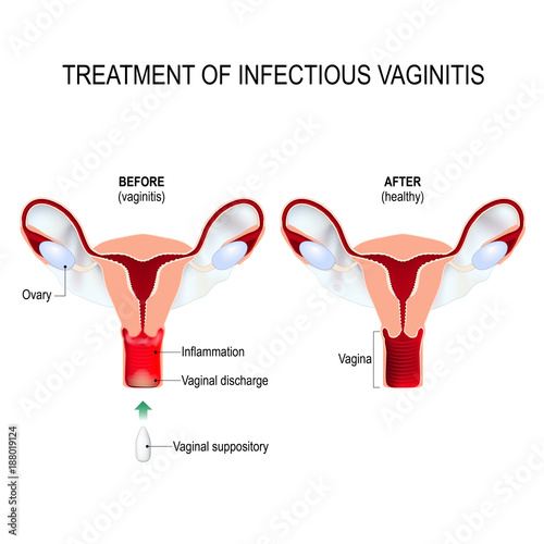 Treatment of infectious vaginitis