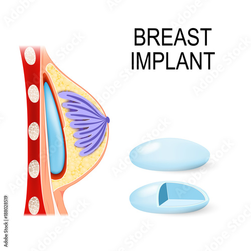 Breast Implant. The surface and Cross section view of the silicone breast implant