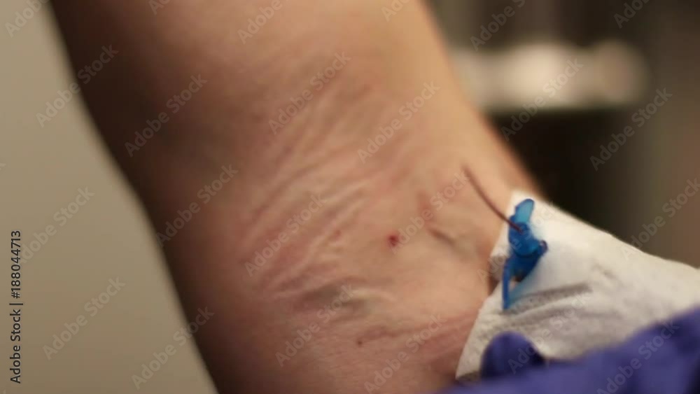 Nurse Removing Intravenous Catheter From Patient's Arm Stock Video