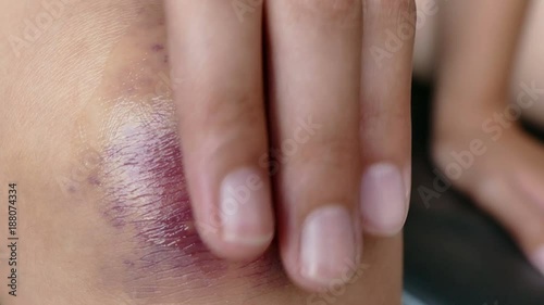4K, A girl rubs her fingers with a curative ointment in a bruised knee 