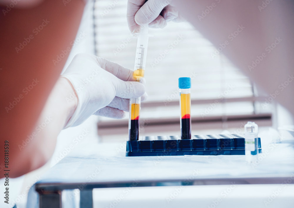 Platelet-Rich plasma preparation. Plasma in syringe. Centrifuge. Platelet-Rich plasma preparation. Plasma in syringe. Centrifuge.