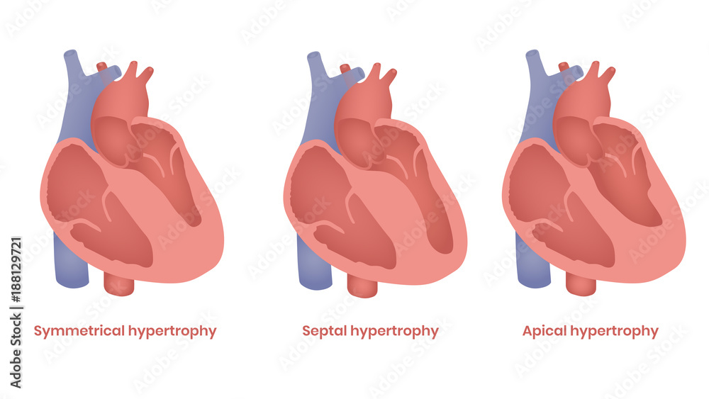 Hypertrophic Cardiomyopathy illustration. Apical, septal and symmetrical types Stock Vector