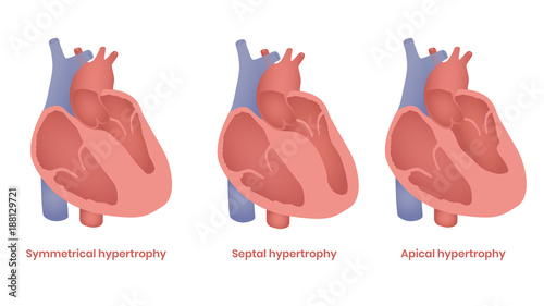 Hypertrophic Cardiomyopathy illustration. Apical, septal and symmetrical types photo