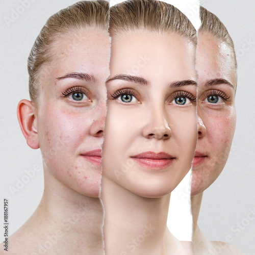 Compare of old photo with acne and new healthy skin.