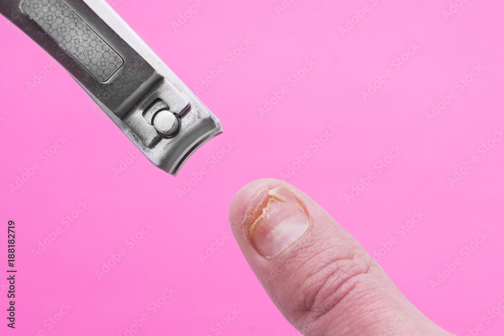 Damage of the nail after using shellac. Onycholysis. Injury of the nail