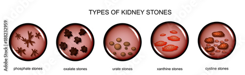 types of kidney stones photo