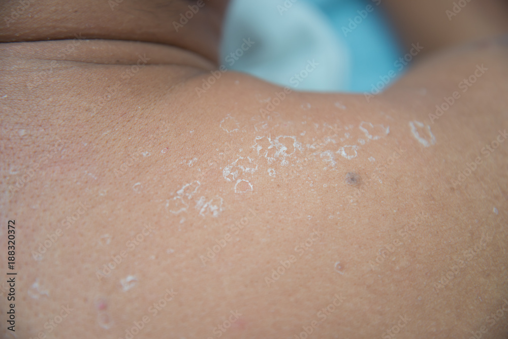 Fototapeta premium Peeling skin from sunburn