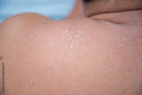 Peeling skin from sunburn