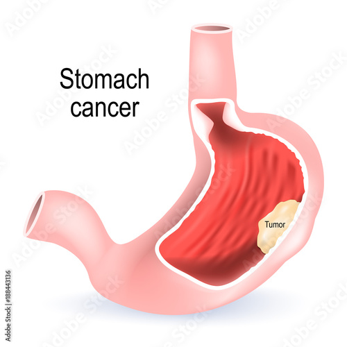 Stomach cancer