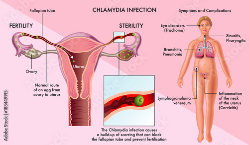 symptoms and complications of Chlamydia Infection
 photo