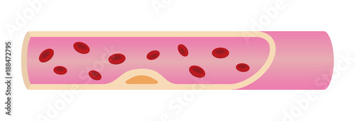 Arteriosclerotic vessel (early stage) illustration