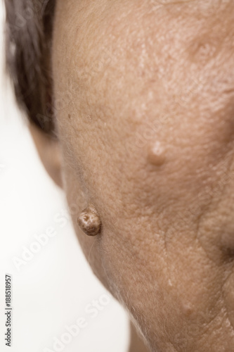 Elderly pensioner female, dermal fibroma closeup.