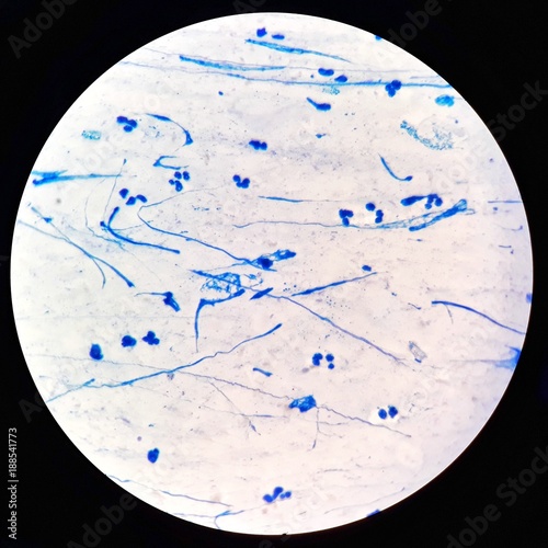 Smear of Acid-Fast bacilli (AFB) stained from sputum specimen, under 100X light microscope, selective focus. photo