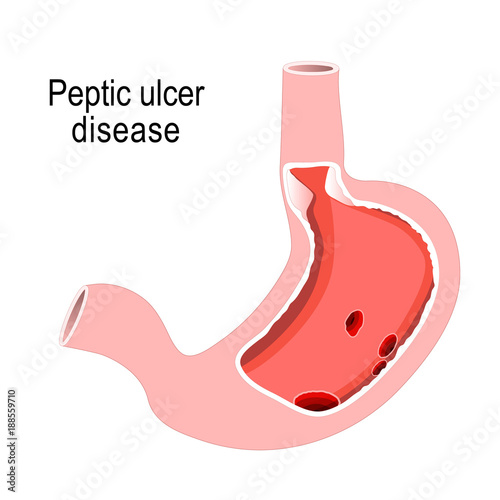 Peptic ulcer disease. Cross section of the humans stomach