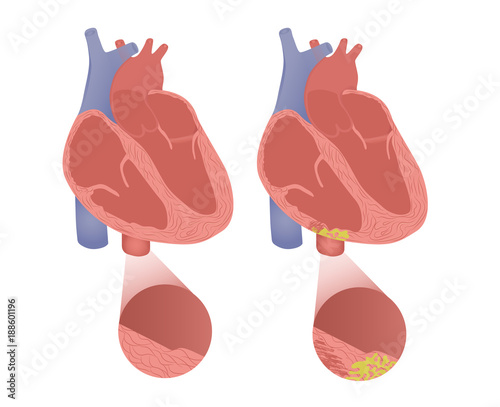 Healthy heart with arrhythmogenic cardiomyopathy. Vector illustration of arrhytmogenic right ventricular dysplasia