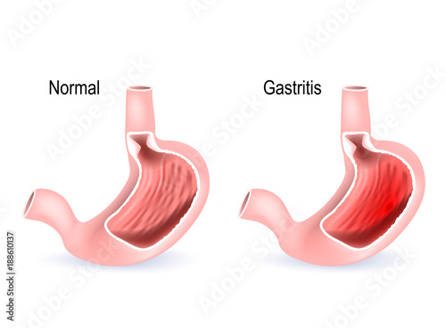 Gastritis. Cross section of two stomach