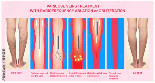 Varicose Veins and Treatment with radiofrequency ablation
