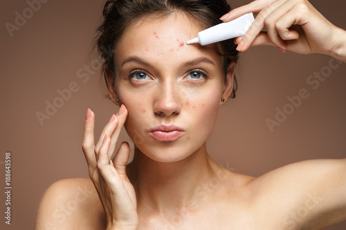 Fototapeta Naklejka Na Ścianę i Meble -  Teen girl with problem skin applying treatment cream on beige background. Skin care concept