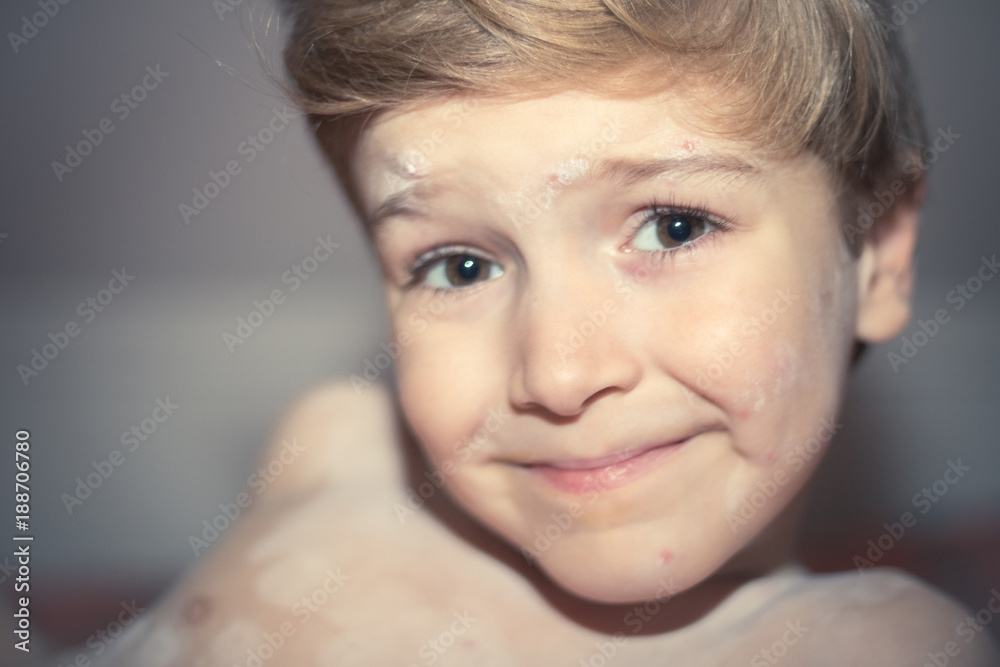 Little boy with chickenpox. Little boy with chickenpox.