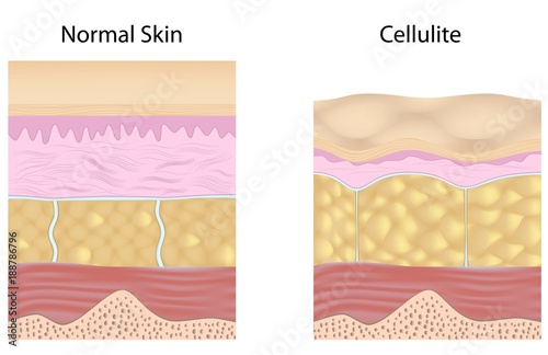 Cellulite versus smooth skin unlabeled photo