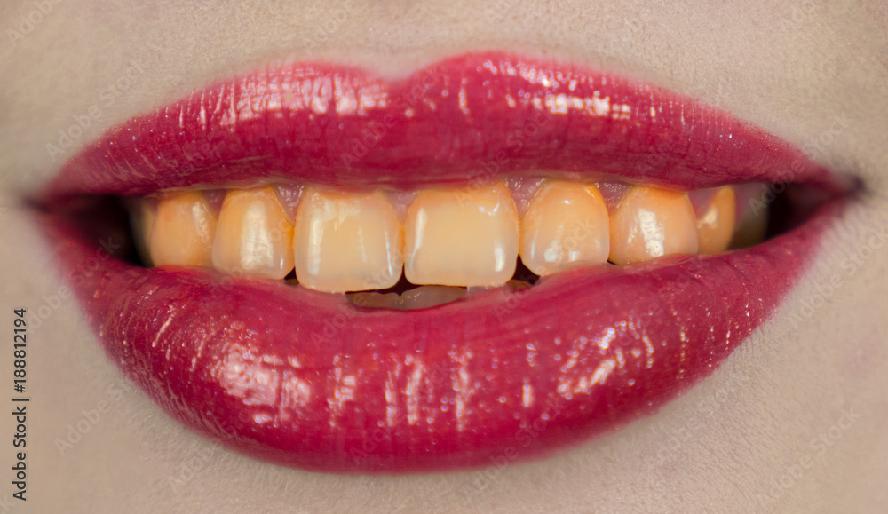 Obraz premium Teeth whitening at the dentist. Stomatology and dental clinic concept. Before and after. White tooth smile. White and yellow teeth, plaque cleaning on teeth. Whitening toothpaste, healthy teeth.