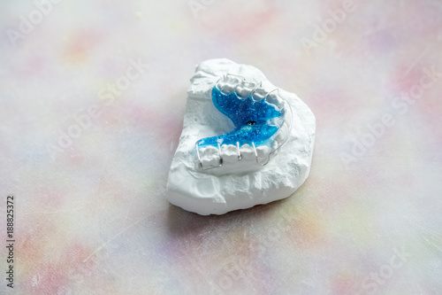 Dental imprint with braces