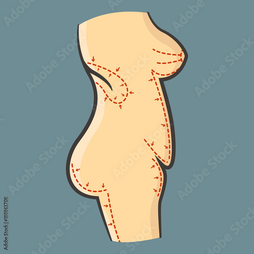 Vector Illustration of human body for liposuction