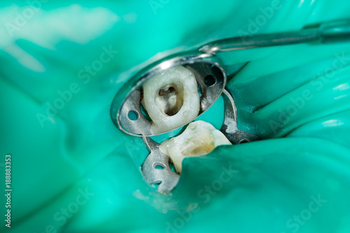 treatment and restoration of rotten carious tooth after root canal filling endocanal pins from fiberglass and photopolymer sealing material photo