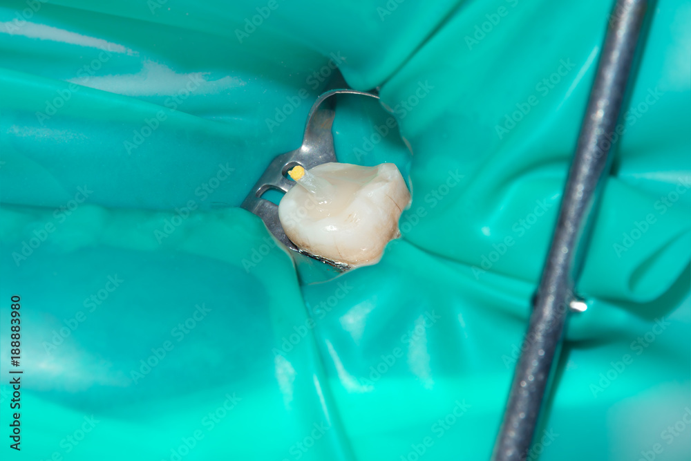 Φωτογραφία treatment and restoration of rotten carious tooth after root canal filling endoc