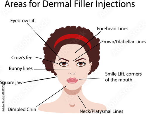 areas for rejuvenation cosmetological injections, vector illustration for salons