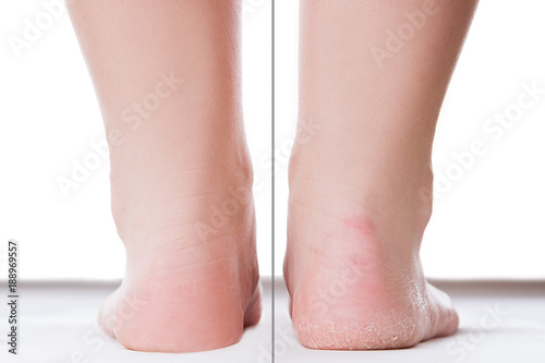 Before after feet care concept, female foot