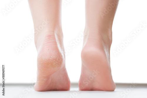 Valokuva Before after feet care concept, female foot