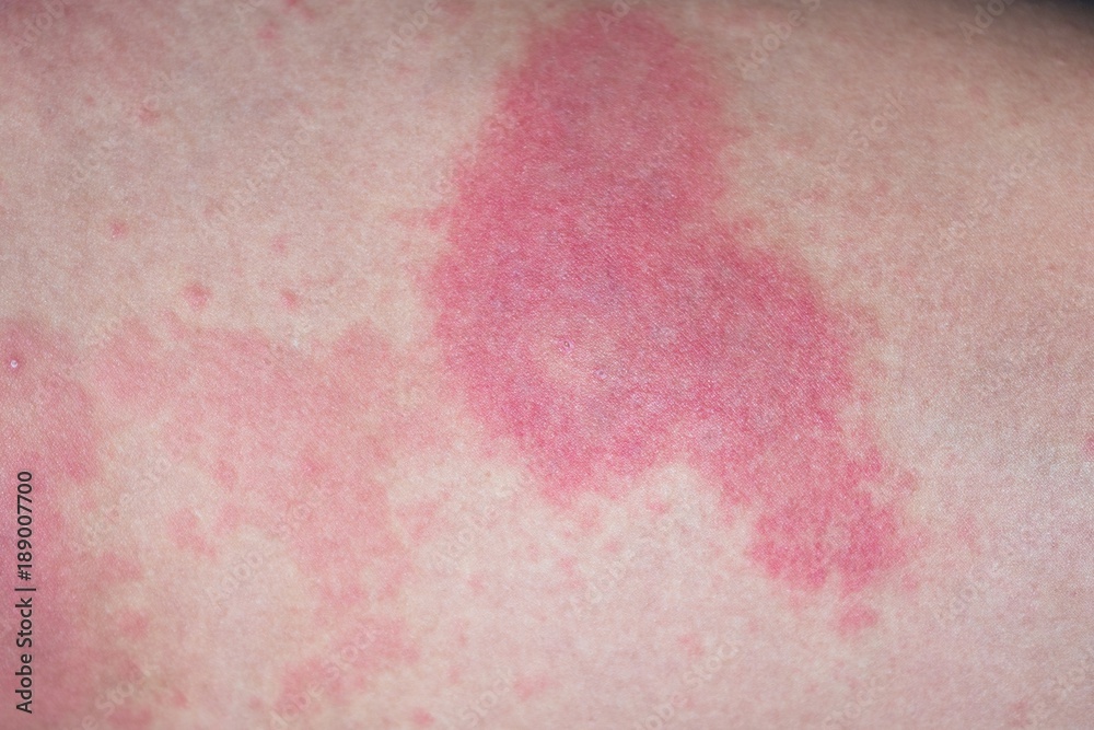 Fototapeta premium Itchy urticaria on woman leg