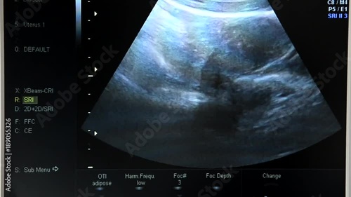 Screen of  ultrasound machine. 