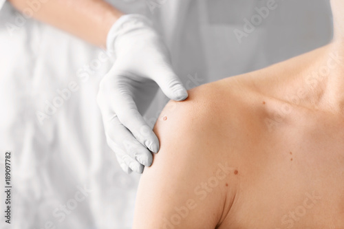 Dermatologist examining birthmark of patient, closeup. Cancer concept