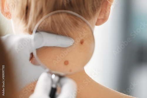 Schilderij op canvas Dermatologist examining birthmark of patient, closeup