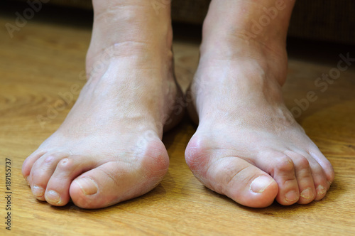 Problem feet with bunion (Hallux valgus) © GarkushaArt