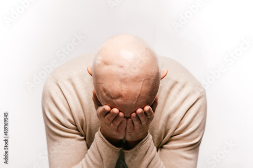 Billede på lærred Bald man psychological stress struggling for life arter brain tumor