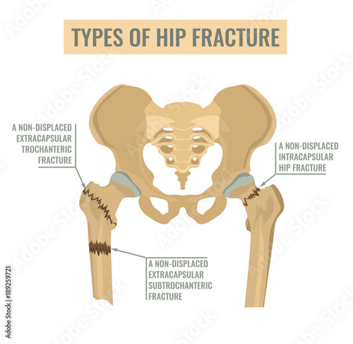 Types of hip fracture