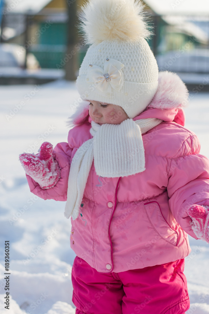 beautiful baby girl with frostbitten face or with allergic rash on