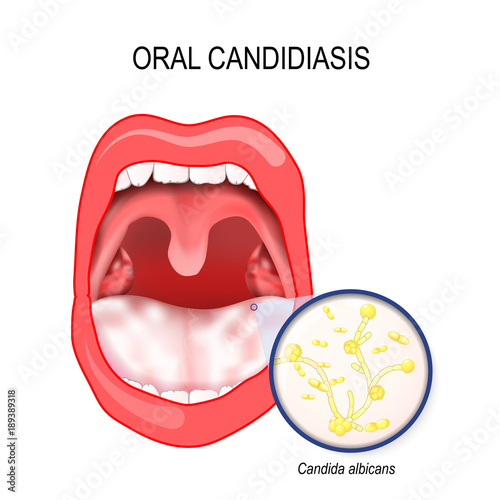oral candidiasis. yeast infection ofl Candida albicans the mouth.