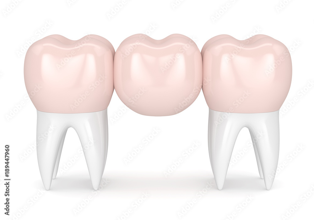 3d render of dental bridge with dental crowns 3d render of dental bridge with dental crowns