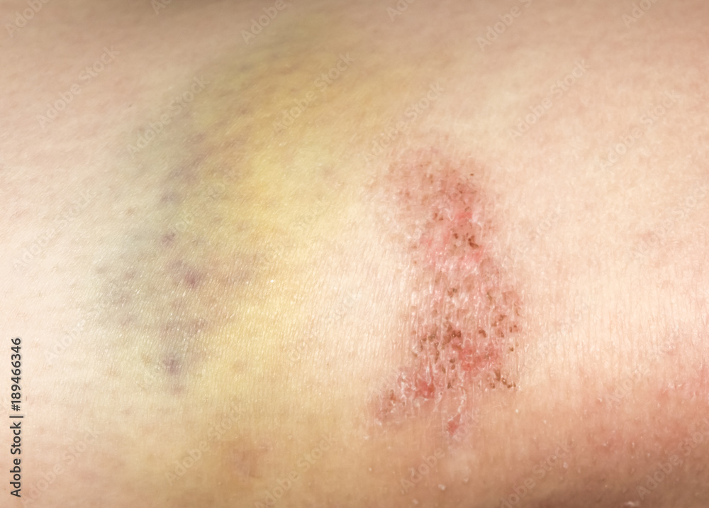 Fototapeta premium Large bruises and abrasions on human skin.