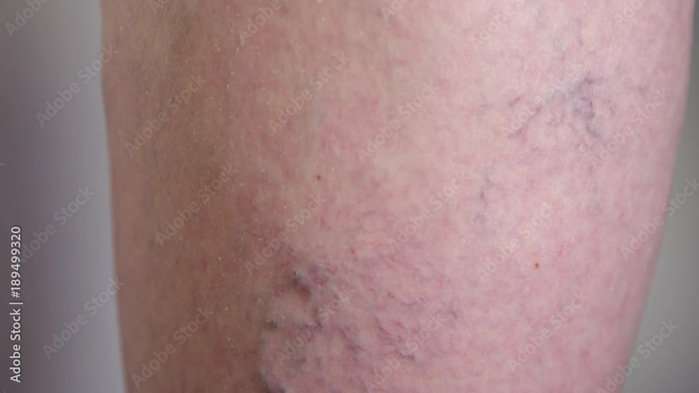 SLOW MOTION, MACRO: Grandmother's problematic enlarged varicose veins running down her calf. Macro of small twisting veins curving down unrecognizable Caucasian woman's leg. Coronary health issue. SLOW MOTION, MACRO: Grandmother's problematic enlarged varicose veins running down her calf. Macro of small twisting veins curving down unrecognizable Caucasian woman's leg. Coronary health issue.