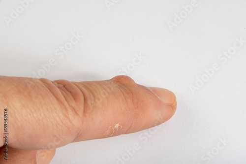 Ganglion Cysts